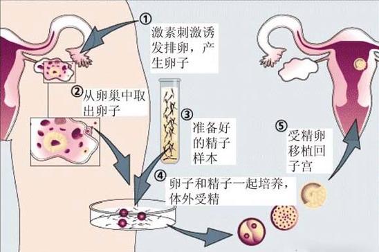 深圳试管供卵孩子包成功【深圳试管供卵孩子包成功指南】