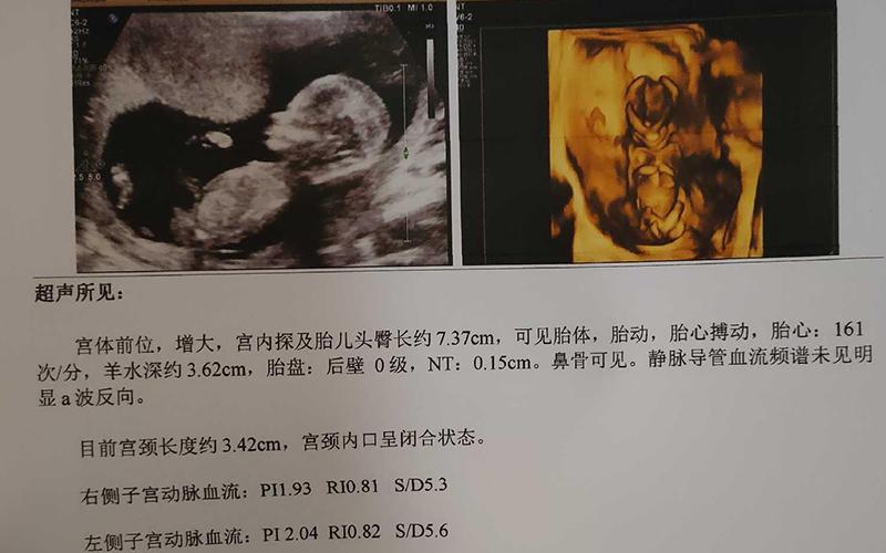 深圳三代供卵试管双胞胎【深圳三代供卵试管双胞胎：医学科技的奇迹】